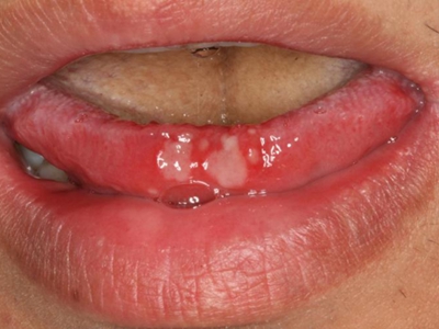 舌头边缘溃疡图片图片