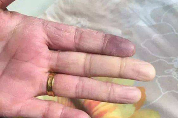 雷诺病手指发紫图