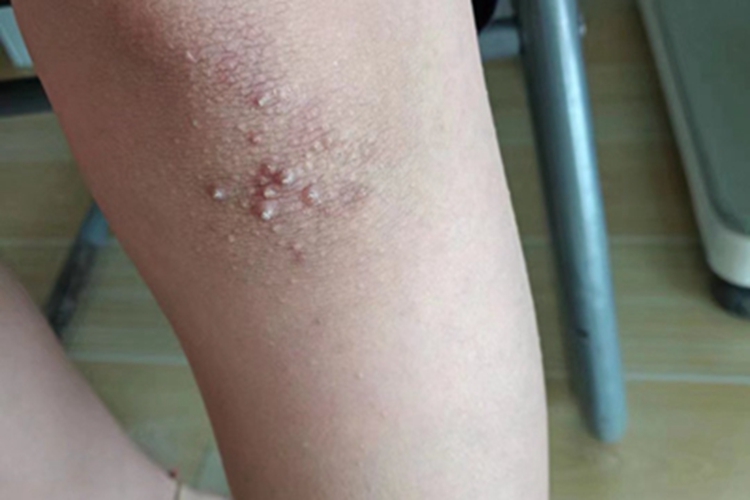 慢性湿疹膝盖下方有丘疹图