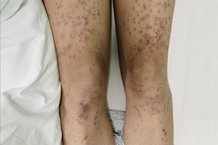 急性皮肤型红斑狼疮腿部丘疹图