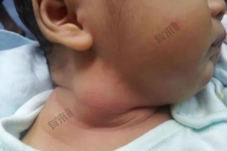 胸锁乳突肌条索状突起图