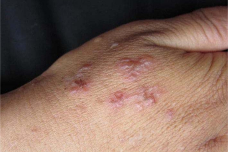 家族性良性慢性天疱疮手背症状图
