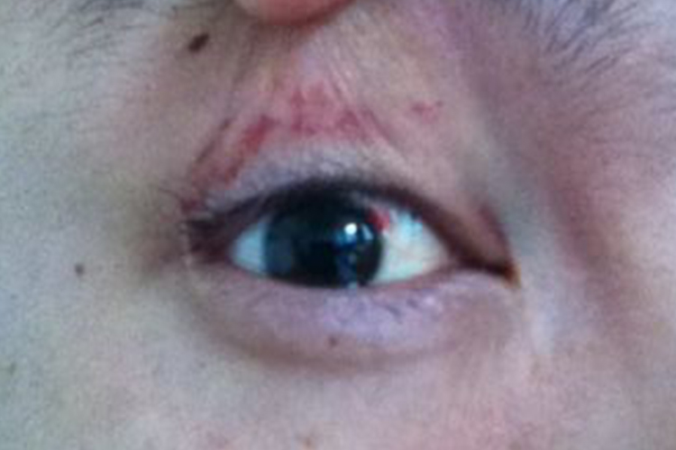 眼部外伤图
