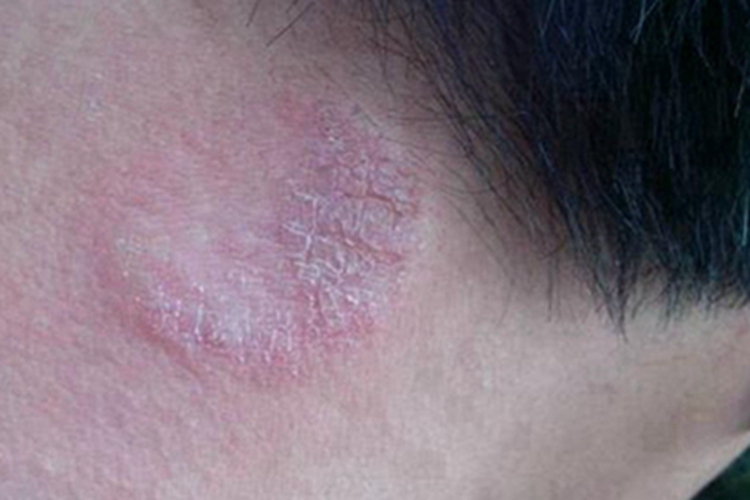 苔藓状淀粉样变颈部症状图