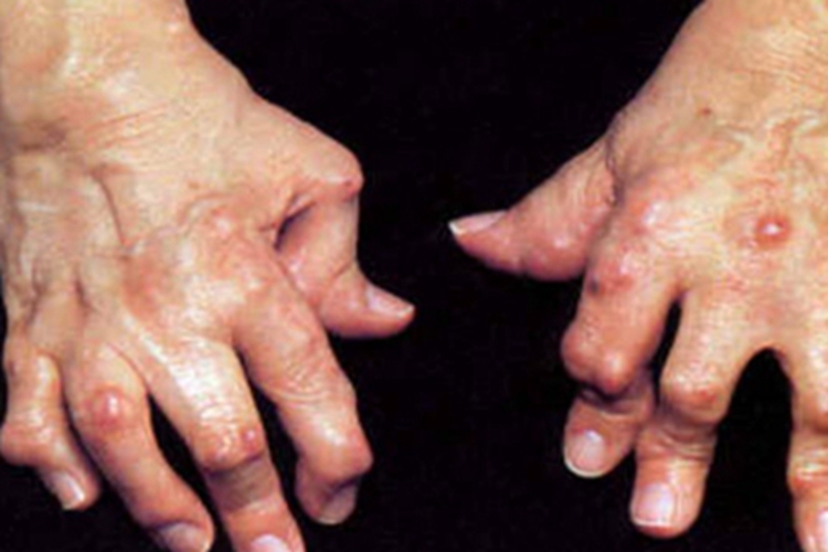 费尔蒂综合征手指畸形图