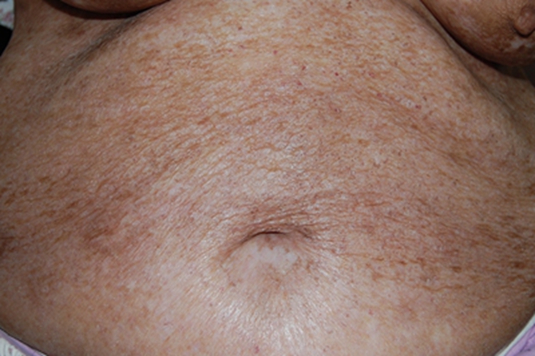 干性湿疹腹部斑图