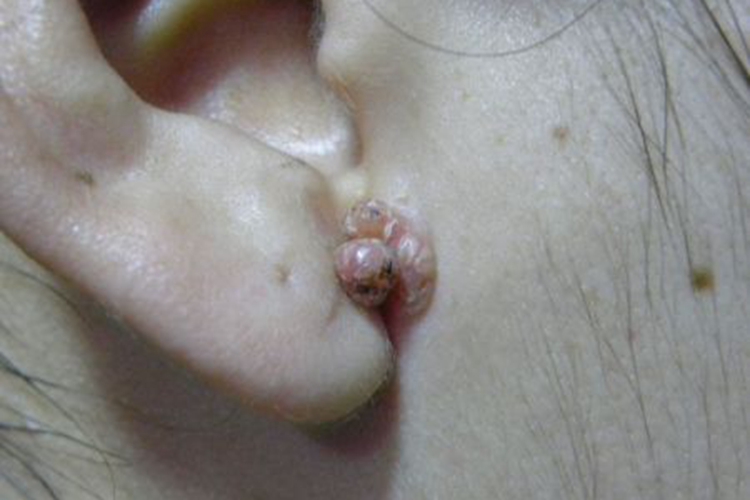 寻常疣耳部肉球图 寻常疣耳部肉球图