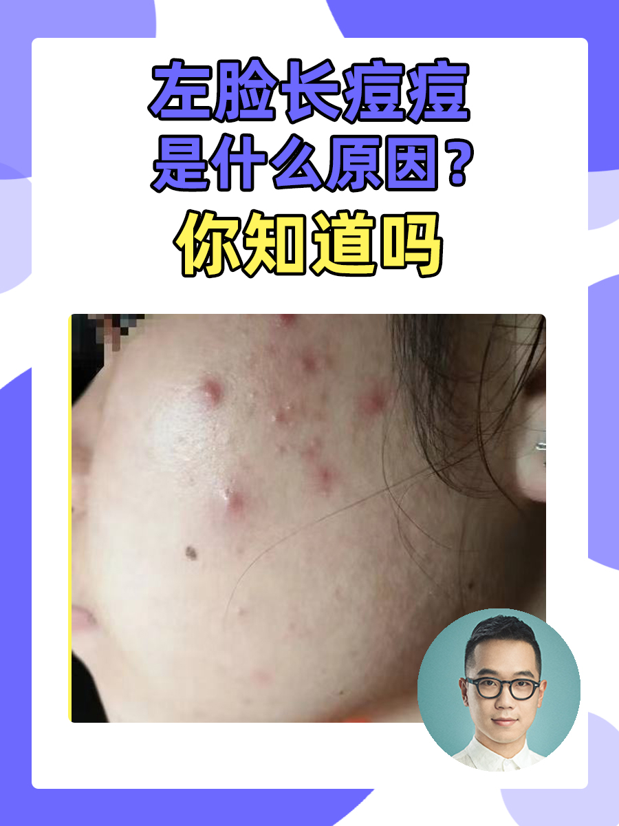 左脸长痘痘是什么原因?你知道吗