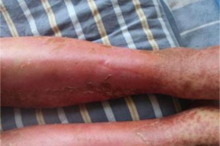 银屑病关节炎小腿红斑图 银屑病关节炎小腿红斑图