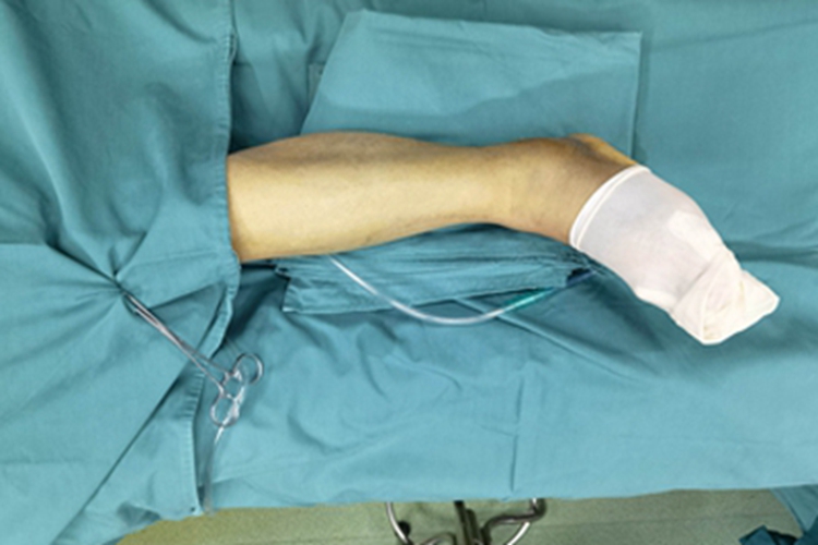 踝关节骨折脚踝畸形图