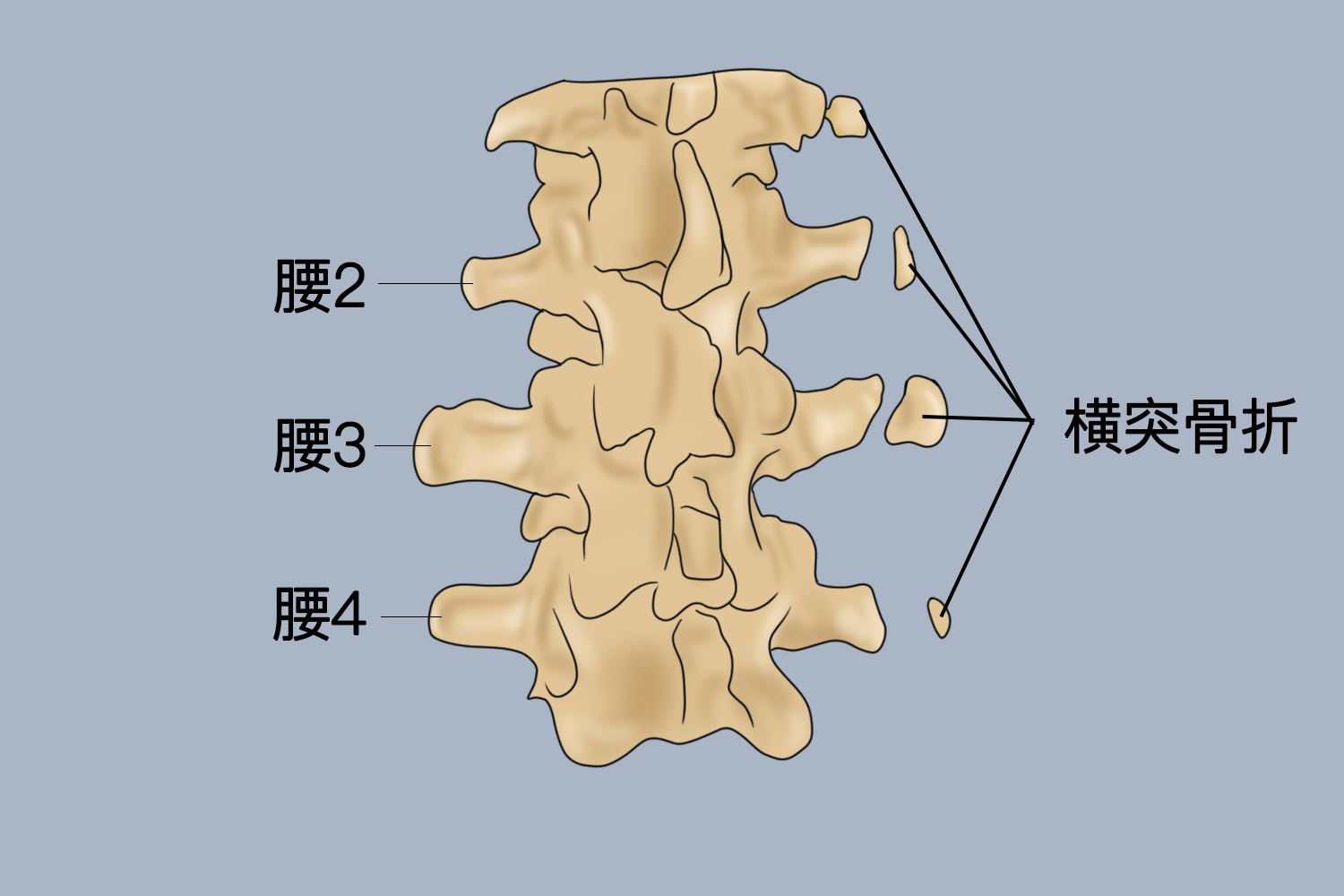 腰椎234横突骨折图