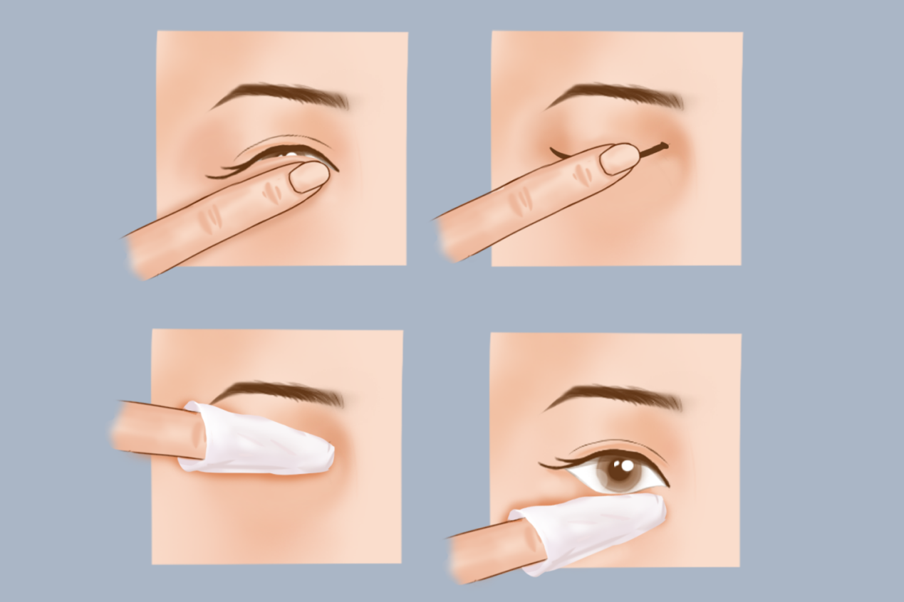 睑板腺按摩流程图