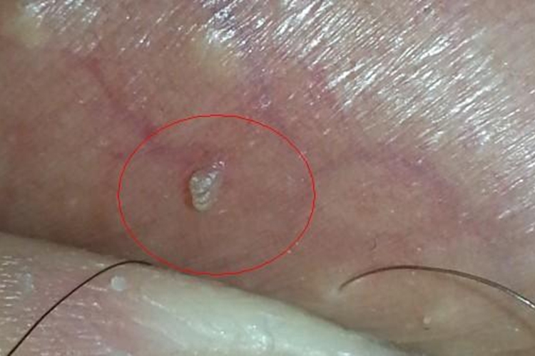 男性阴囊丝状疣图