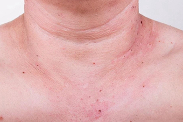 樱桃状血管瘤颈部肉粒图