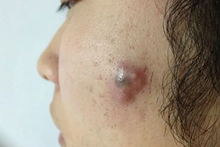 颜面疖痈症状图 颜面疖痈症状图