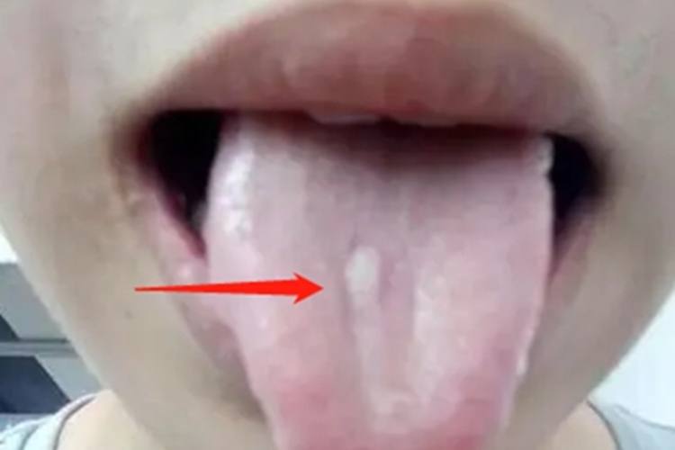 口腔黏膜结核初疮舌头白斑图 口腔黏膜结核初疮舌头白斑图