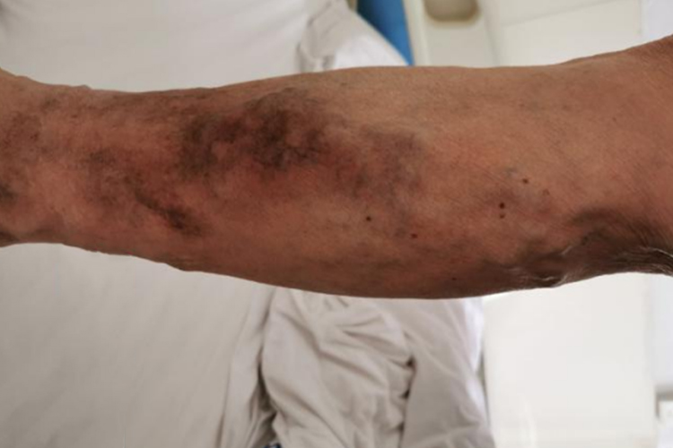 下肢静脉曲张小腿皮肤发黑图