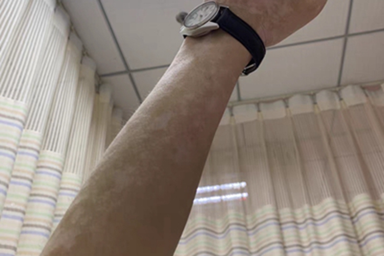 白癜风胳膊白斑图