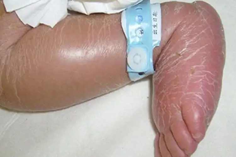 新生儿硬肿症症状图 新生儿硬肿症症状图