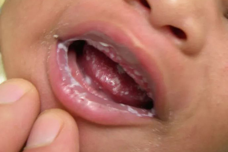 鹅口疮舌头下面有白斑图