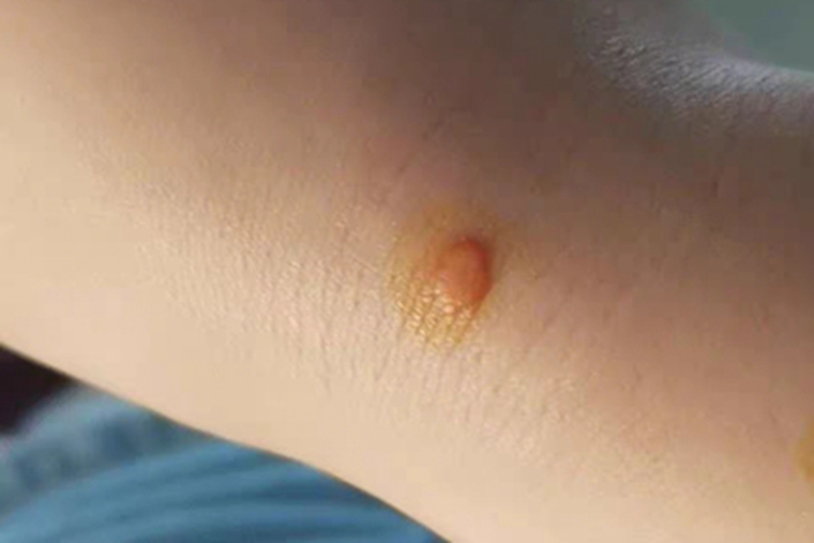 疣手腕疙瘩图 疣手腕疙瘩图