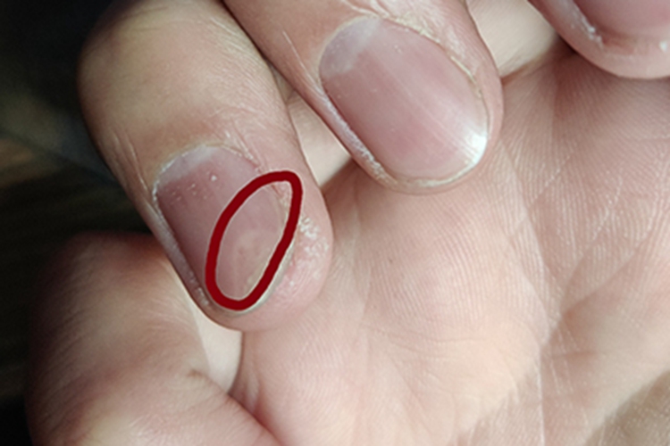 甲凹点甲面有小坑图