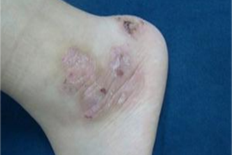 体虱病皮肤增厚图