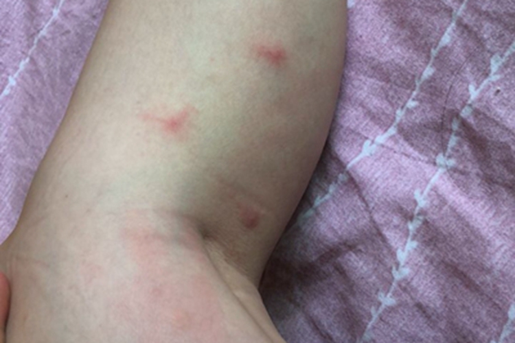 虫咬皮炎小腿大红疙瘩图
