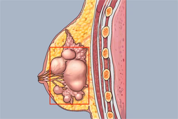 乳腺囊性增生症手绘图