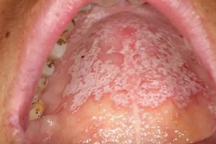 女人艾滋病晚期口腔念珠菌感染图