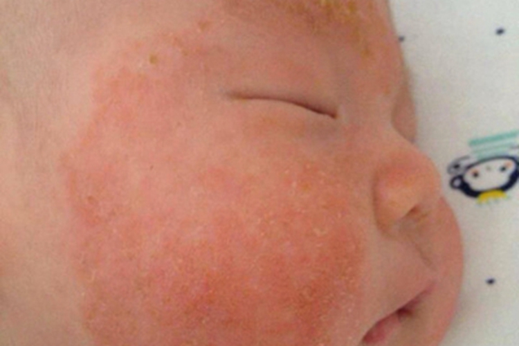 婴儿期特应性皮炎面部红斑黄痂图