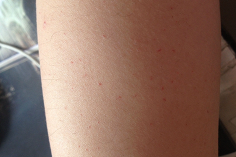 皮下出血胳膊血点图