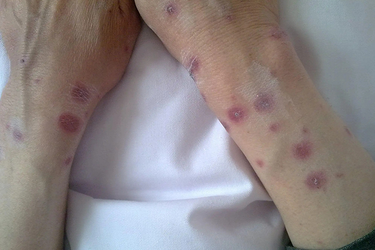 艾滋病初期手臂多形红斑图 艾滋病初期手臂多形红斑图