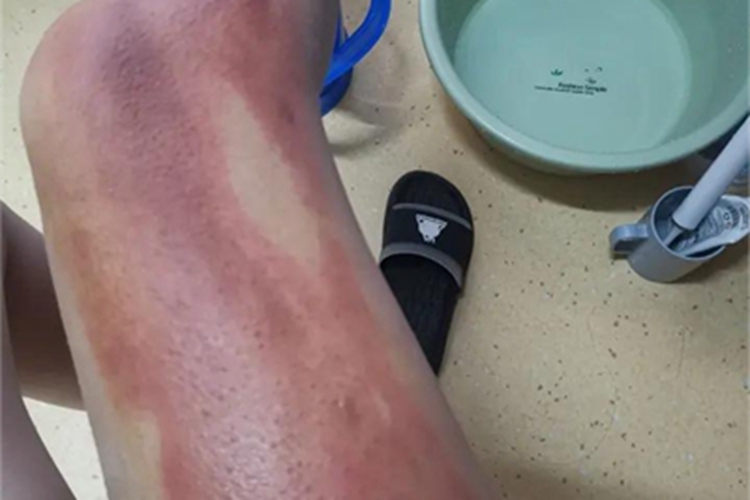 一度烫伤大腿红肿图