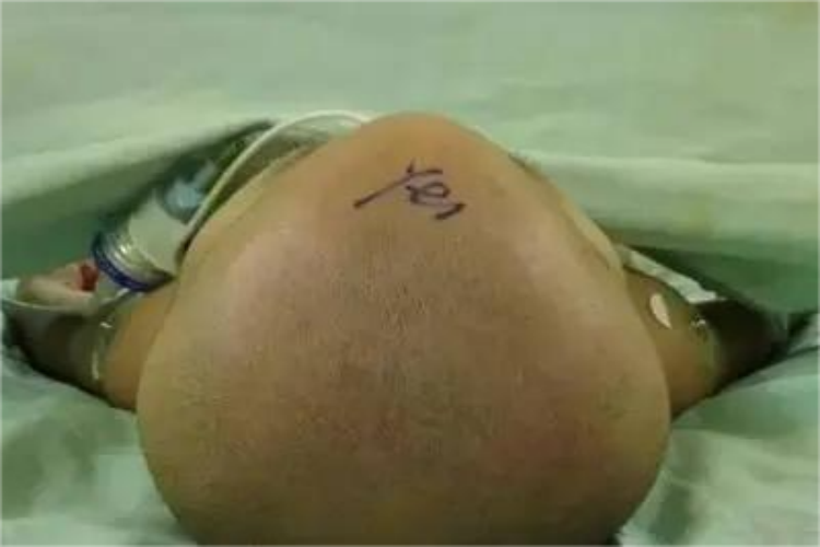 软骨发育不全额骨突出图