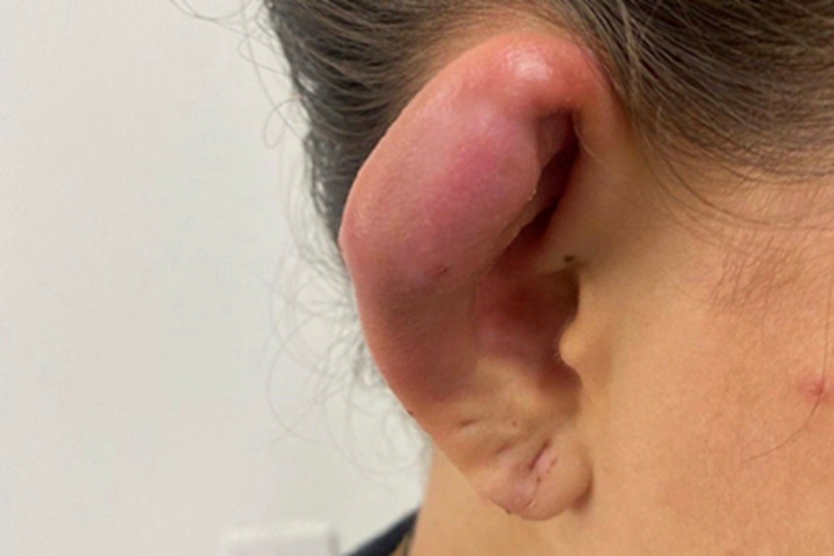 蜂窝织炎耳朵红肿图 蜂窝织炎耳朵红肿图