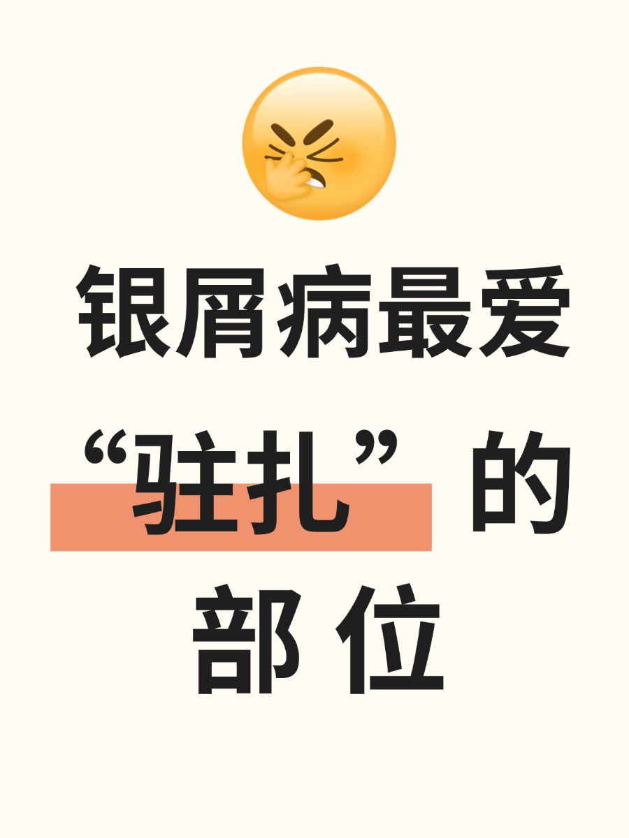 银屑病一般长在什么部位