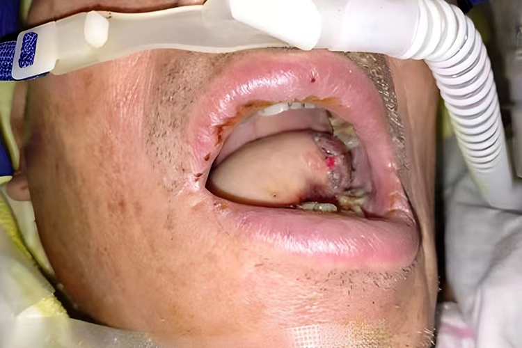 口腔癌术后伤口感染图