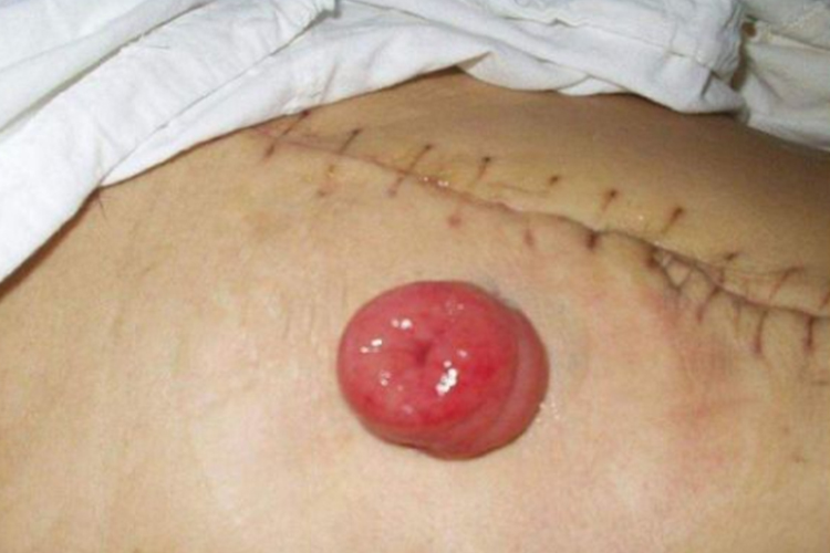 回肠造口正常图