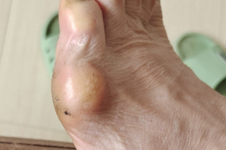 皮肤纤维瘤脚部皮肤增厚图