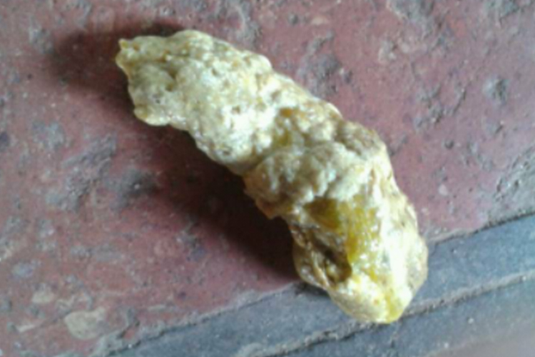 先天性胆总管囊肿大便发白图 先天性胆总管囊肿大便发白图