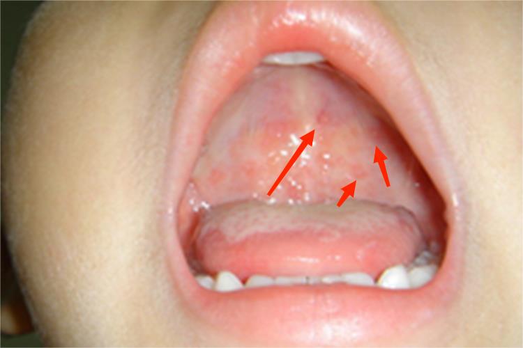 小儿口腔疱疹初期图 小儿口腔疱疹初期图