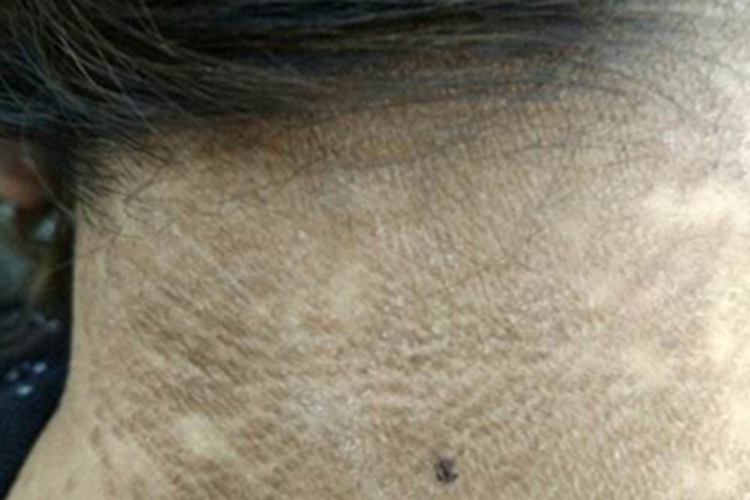 皮肤垢着病后颈皮肤发黑图 皮肤垢着病后颈皮肤发黑图