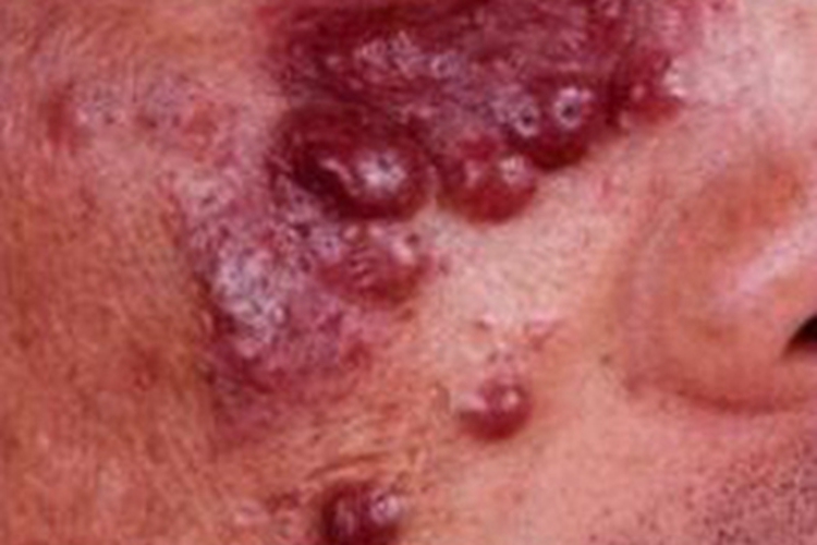 丛状血管瘤面部症状图