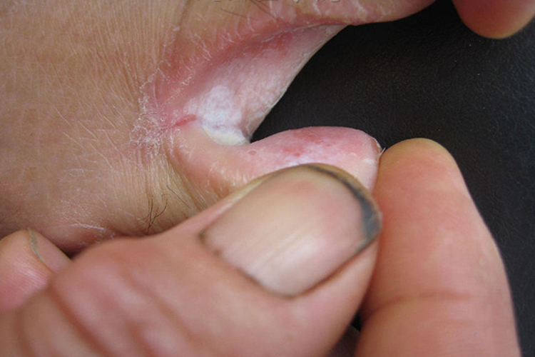 浸渍糜烂型足癣图