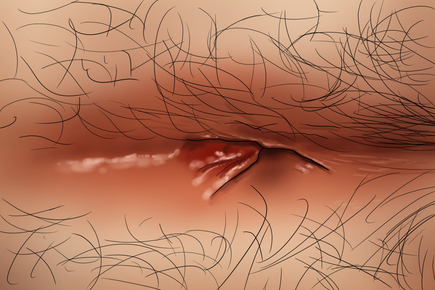 肛裂肛门手绘图