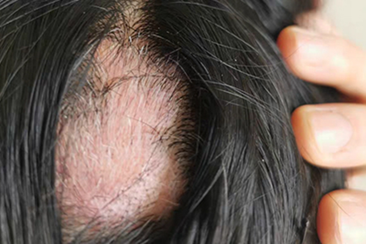 稳定期节段型白癜风头皮白斑图 稳定期节段型白癜风头皮白斑图