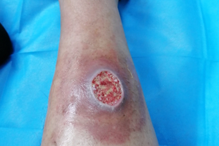 皮肤溃疡溃疡图 皮肤溃疡溃疡图