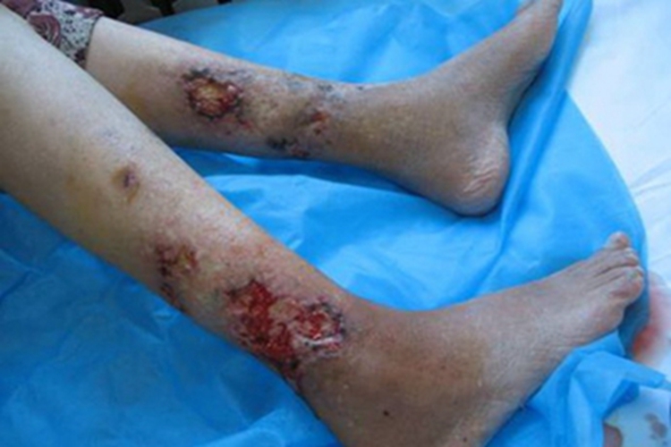 下肢深静脉血栓形成小腿溃疡图