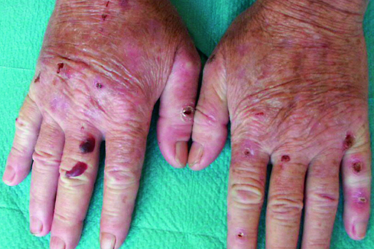 卟啉病皮肤溃烂图